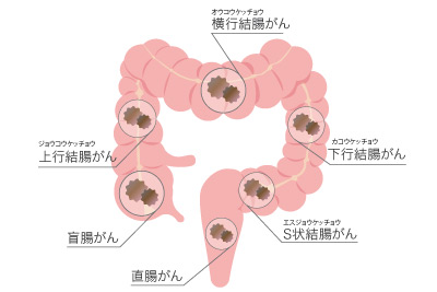 大腸がんイメージ